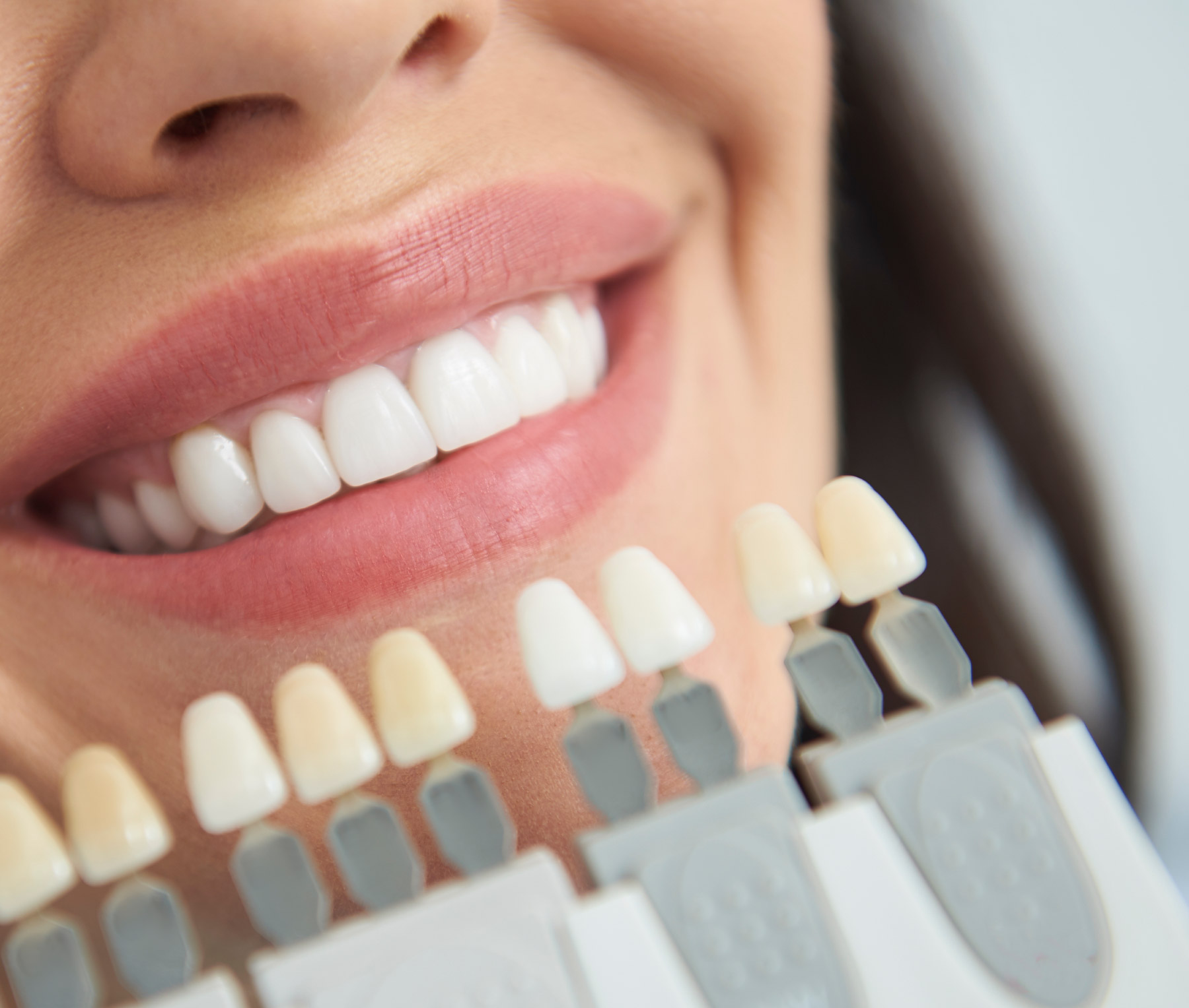 Dental teeth whitening