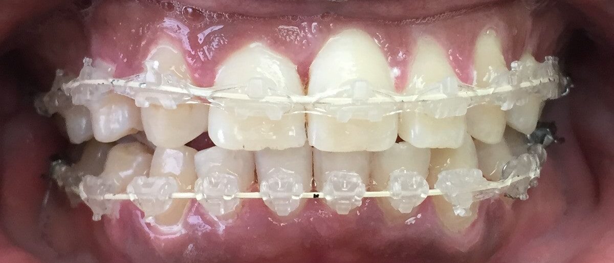 Aesthetika Dental Studio Fastbraces