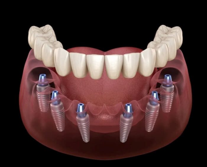 Same-day-Teeth-with-Dental-Implants-Kingston Aesthetika Dental Studio Dental Implants