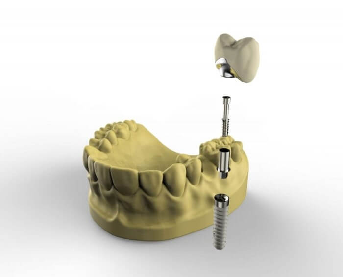 Single-Dental-Implants-Kingston-upon-Thames