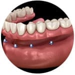 denture-implants-kingston-surrey