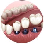 multiple-implants-surrey