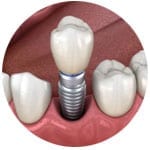 single-implant-kingston-surrey