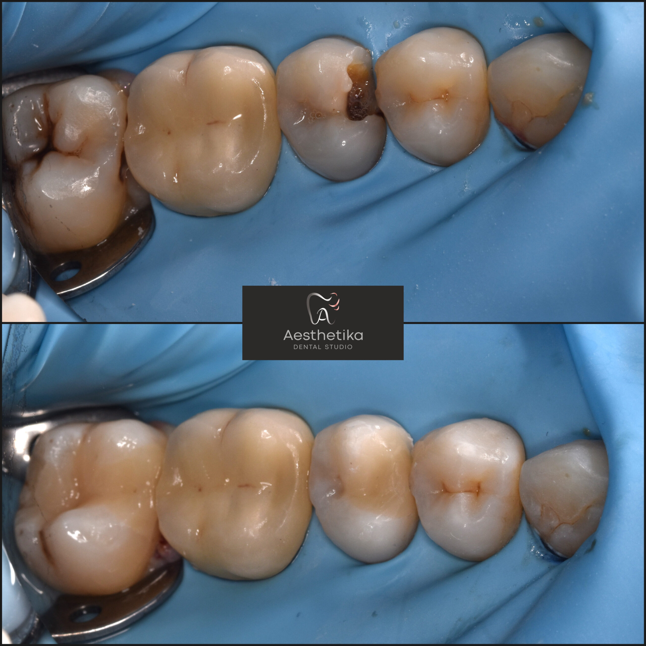 Aesthetika Dental Studio before and after Fillings and Onlays