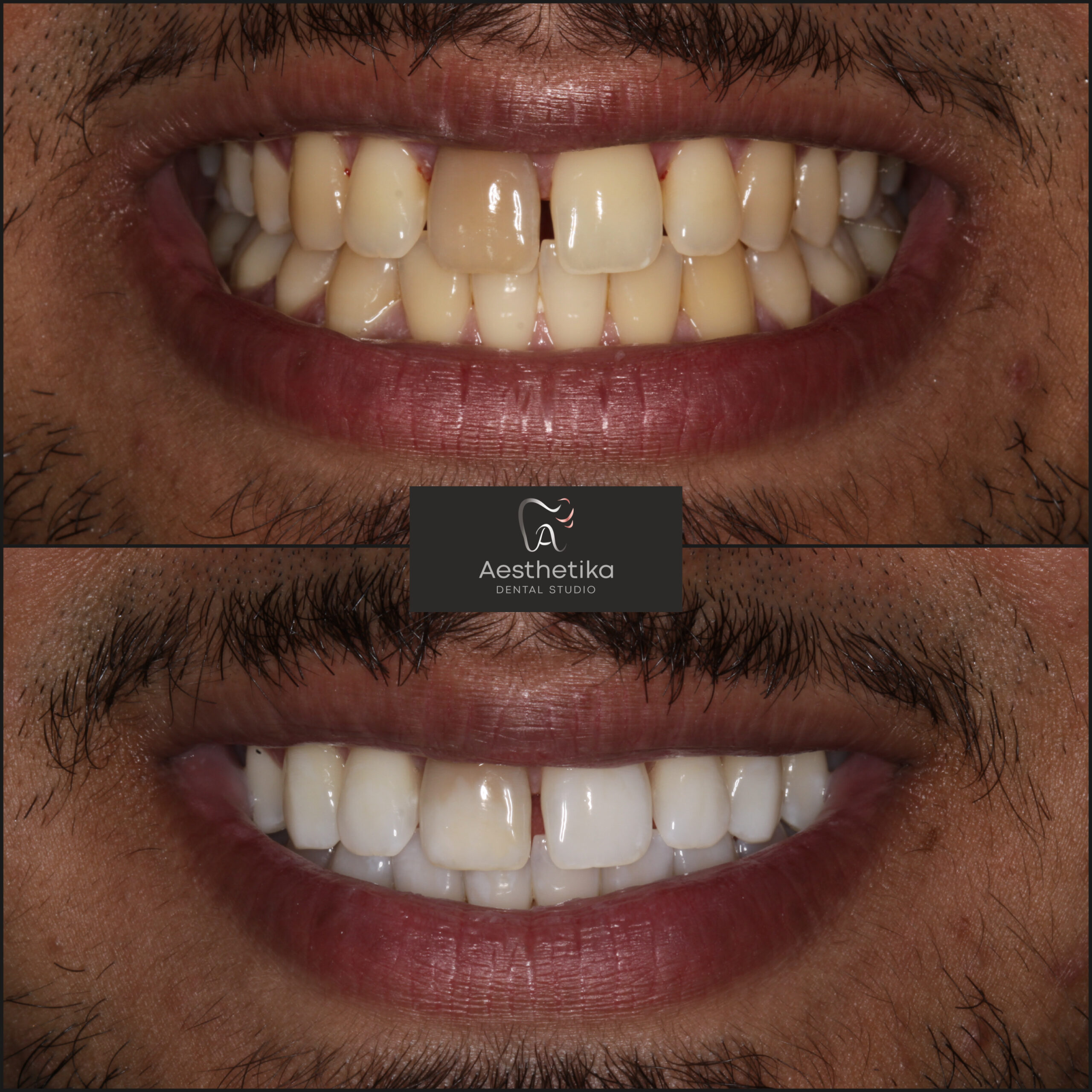 Aesthetika Dental Studio before and after Teeth Whitening
