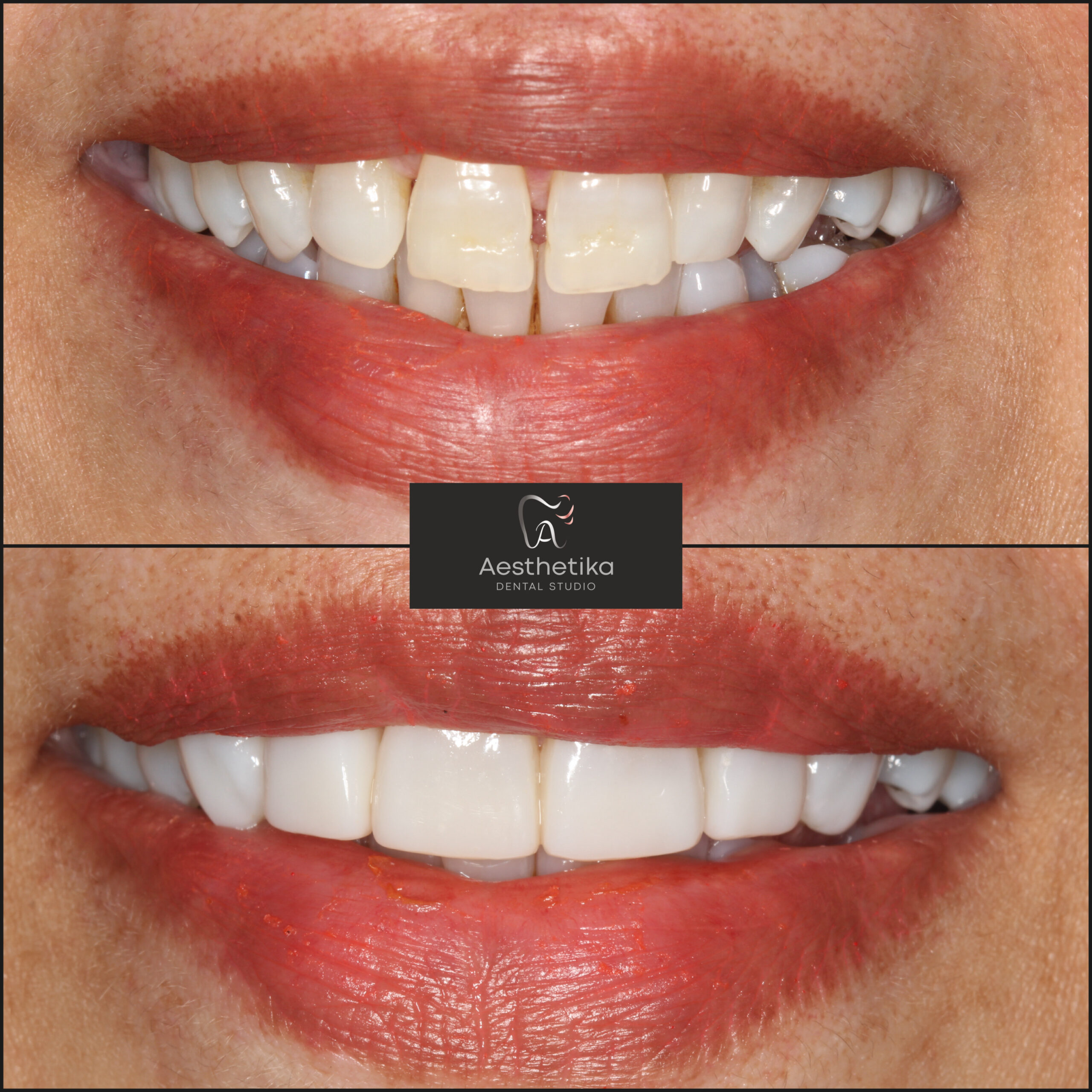 Aesthetika Dental Studio before and after Composite Bonding