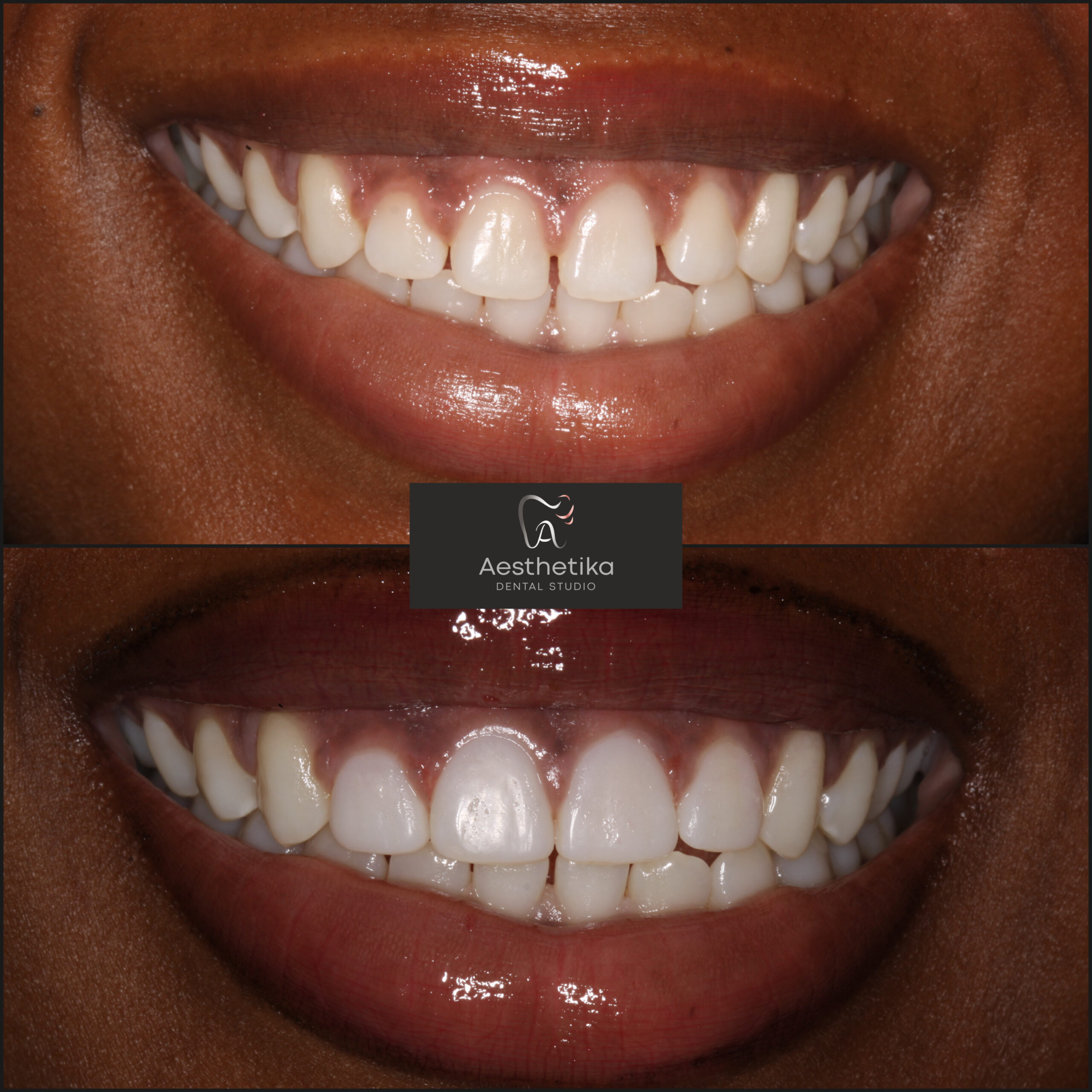 Aesthetika Dental Studio before and after Composite Bonding