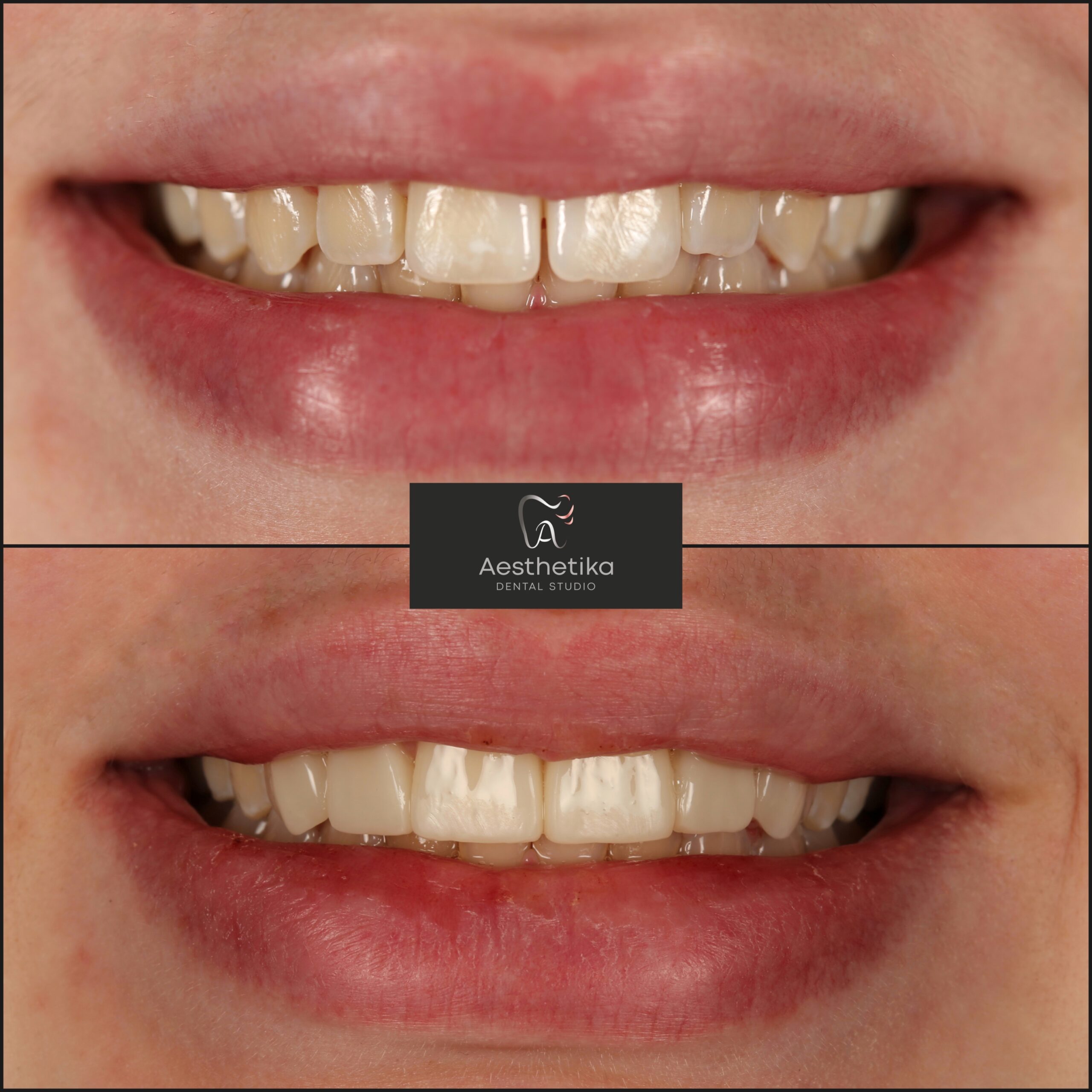 Aesthetika Dental Studio before and after Composite Bonding
