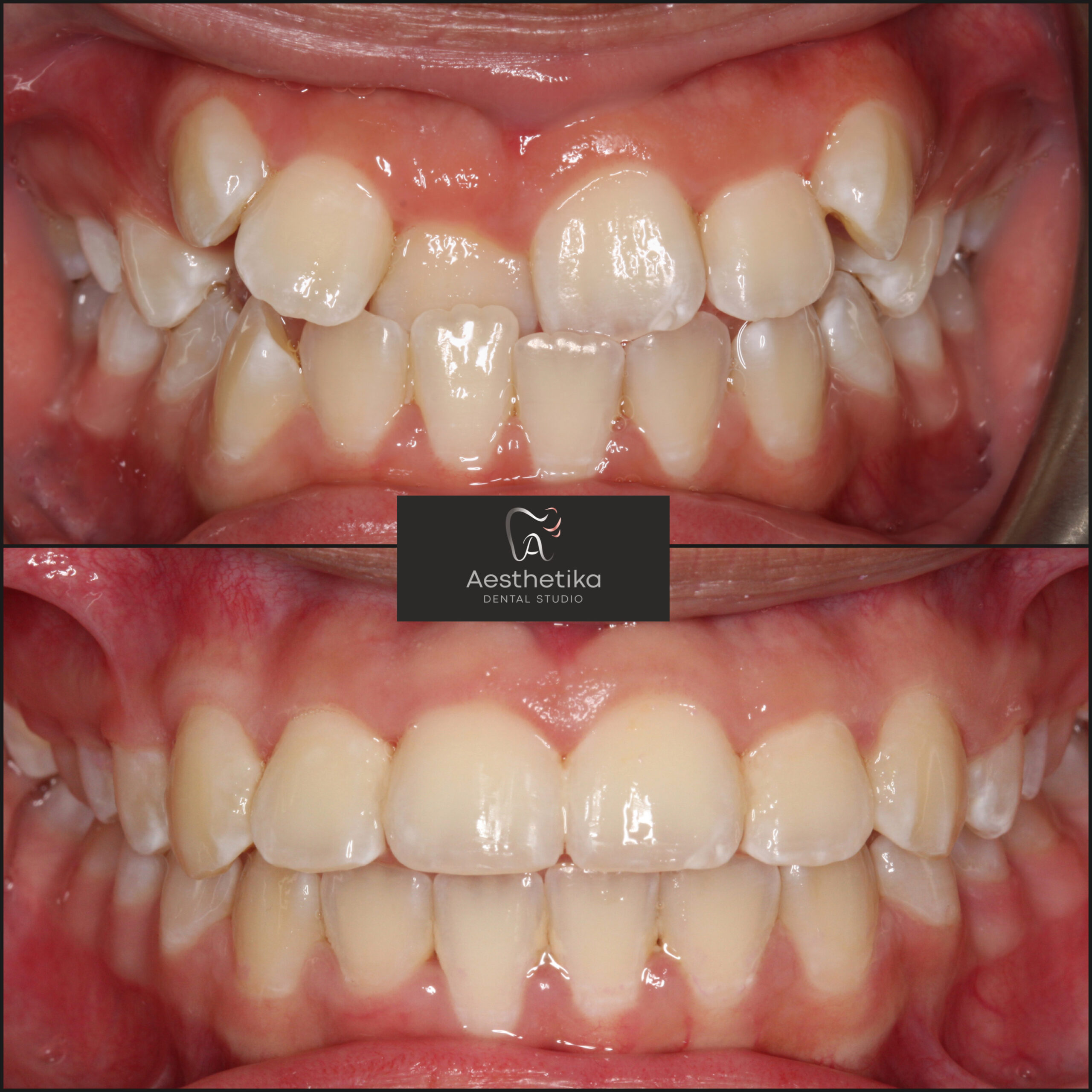 Aesthetika Dental Studio before and after Fastbraces