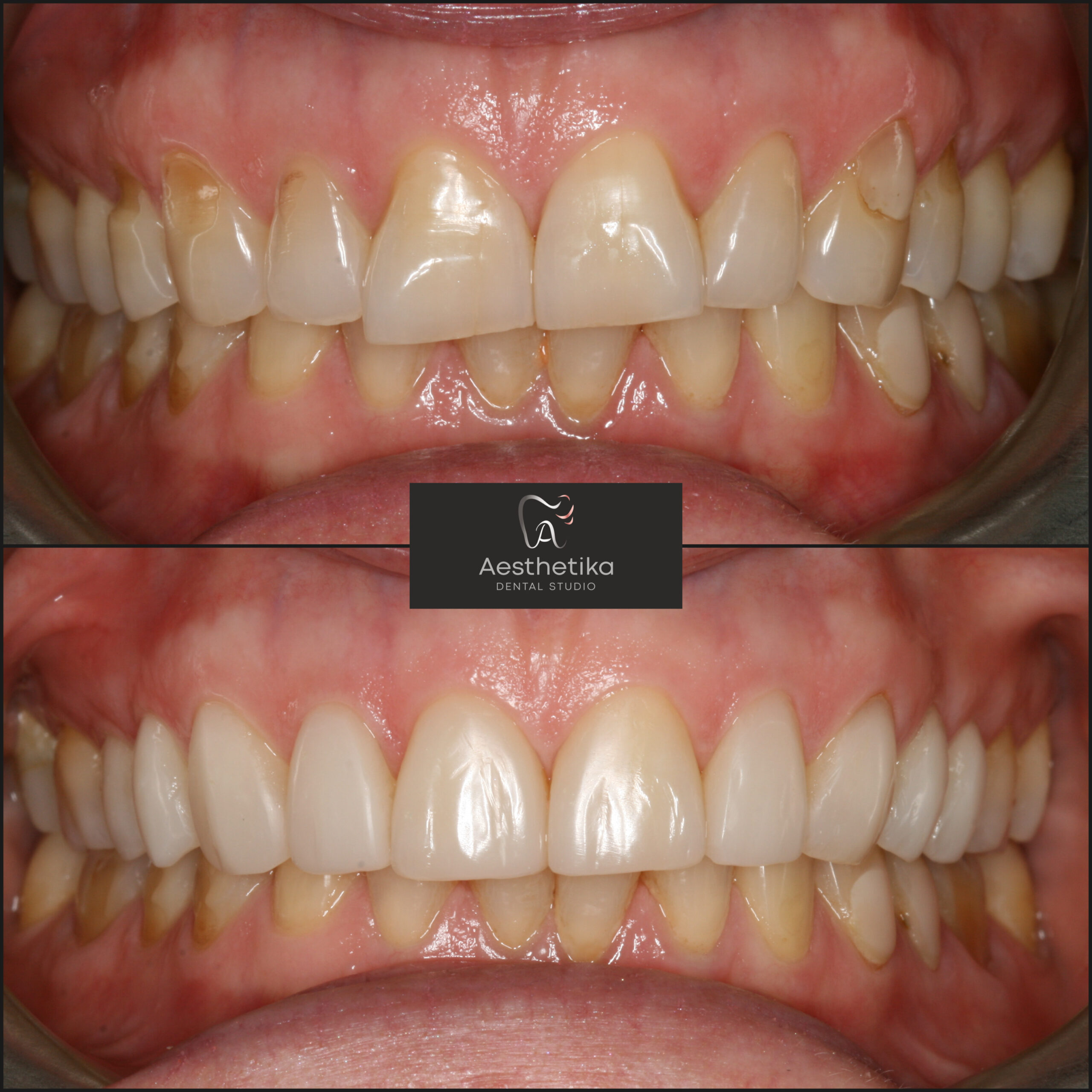 Aesthetika Dental Studio before and after Composite Bonding