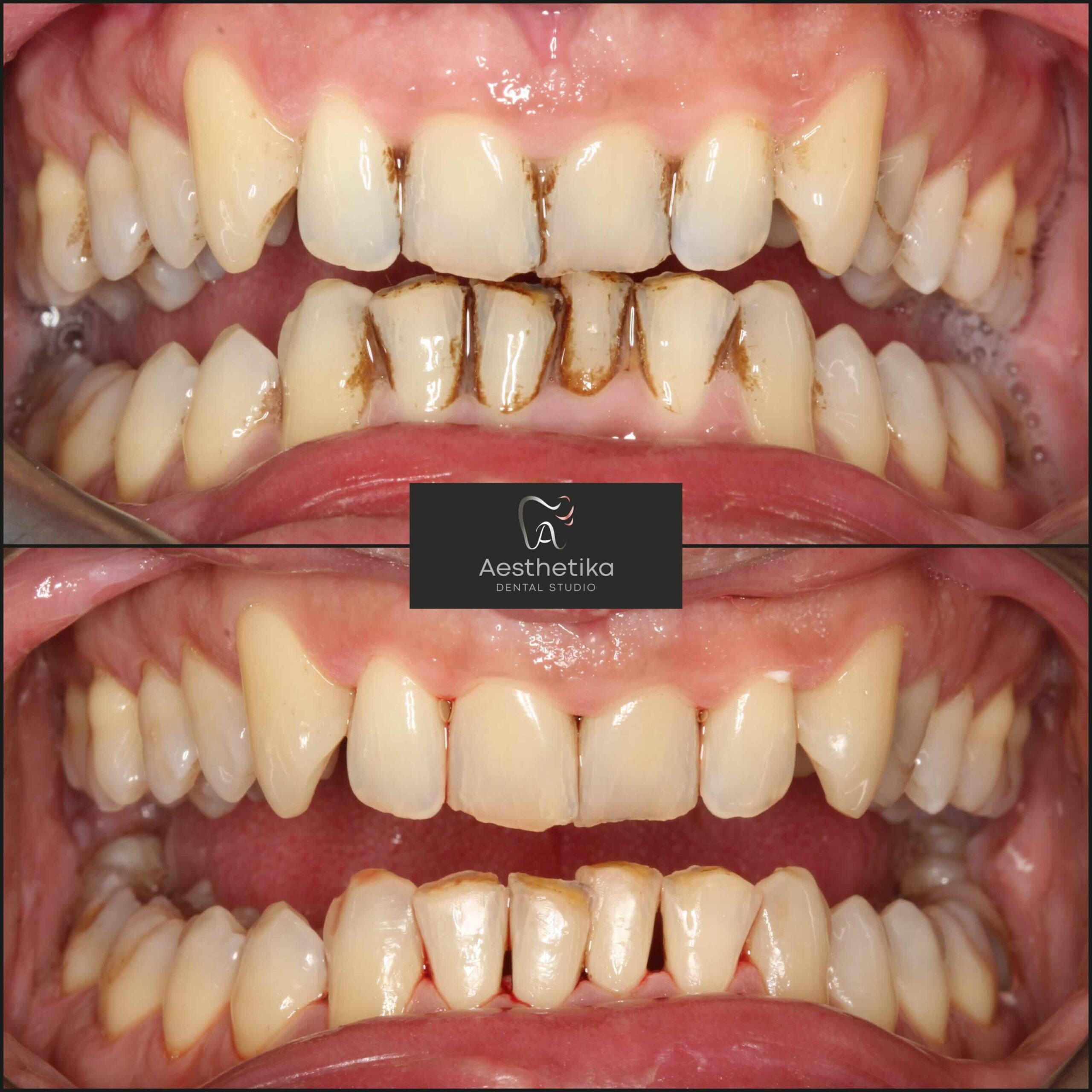 created by photogrid Aesthetika Dental Studio before and after Hygienist and airflow