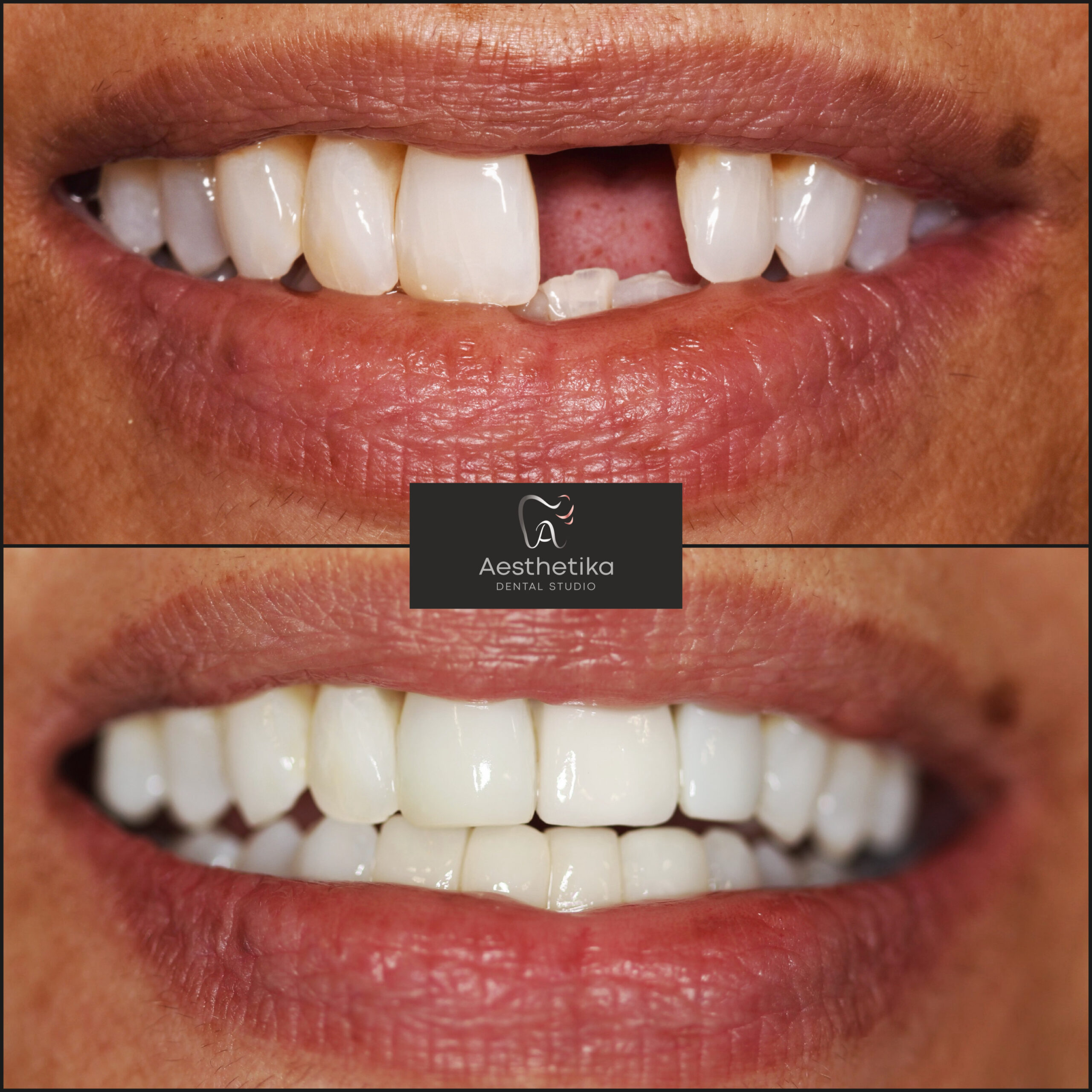 Aesthetika Dental Studio before and after Crowns and Bridges