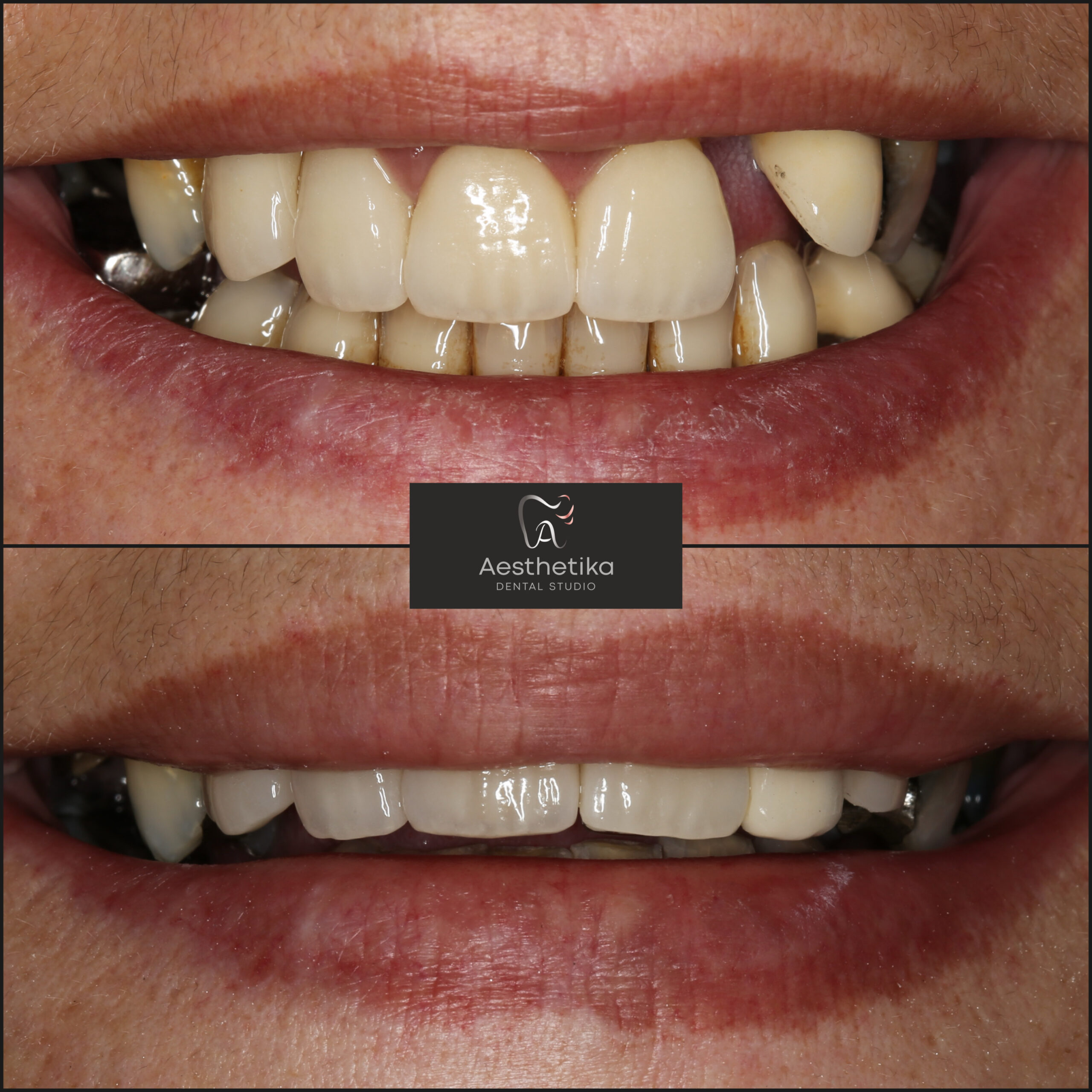 Aesthetika Dental Studio before and after Crowns and Bridges
