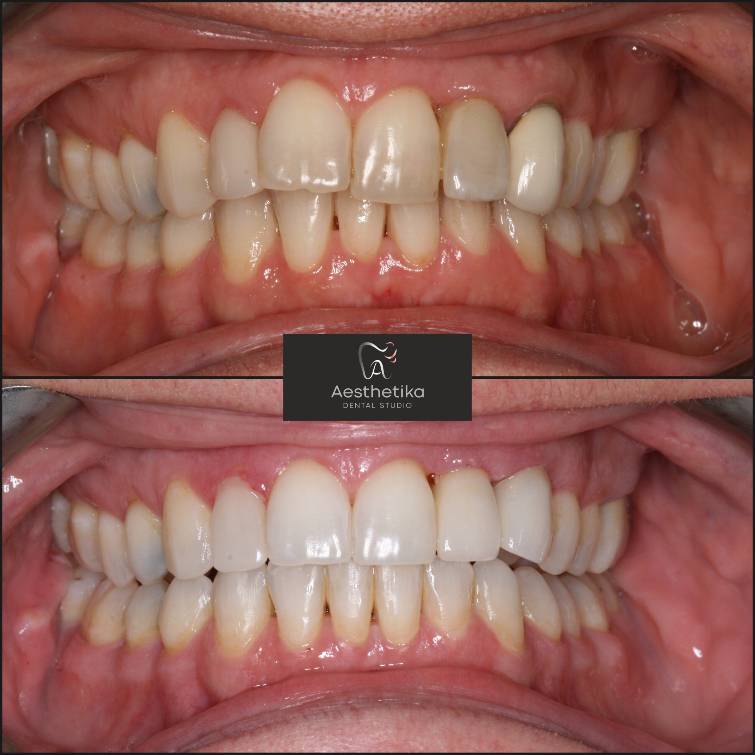 Aesthetika Dental Studio before and after Fastbraces