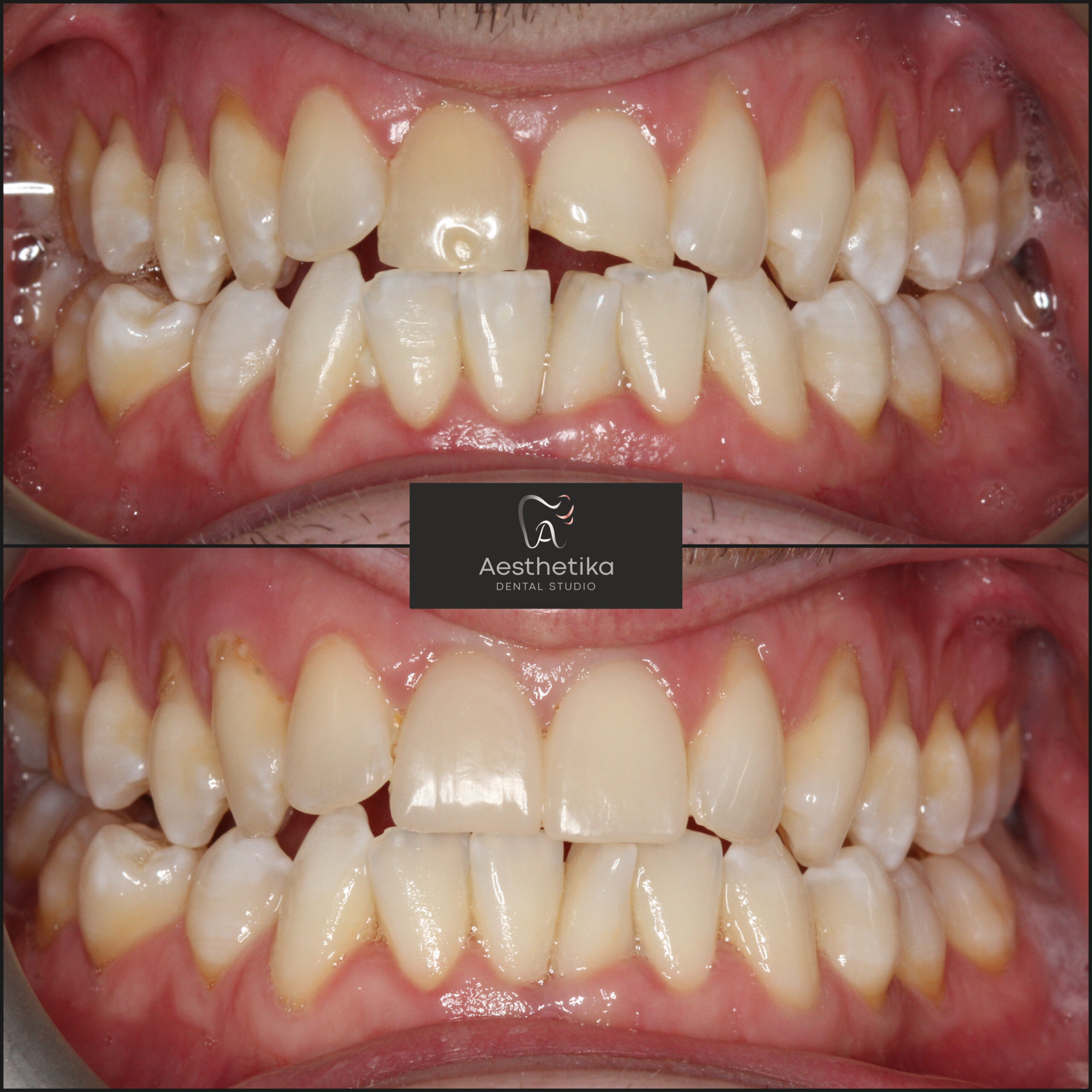 Aesthetika Dental Studio before and after Fillings and Onlays