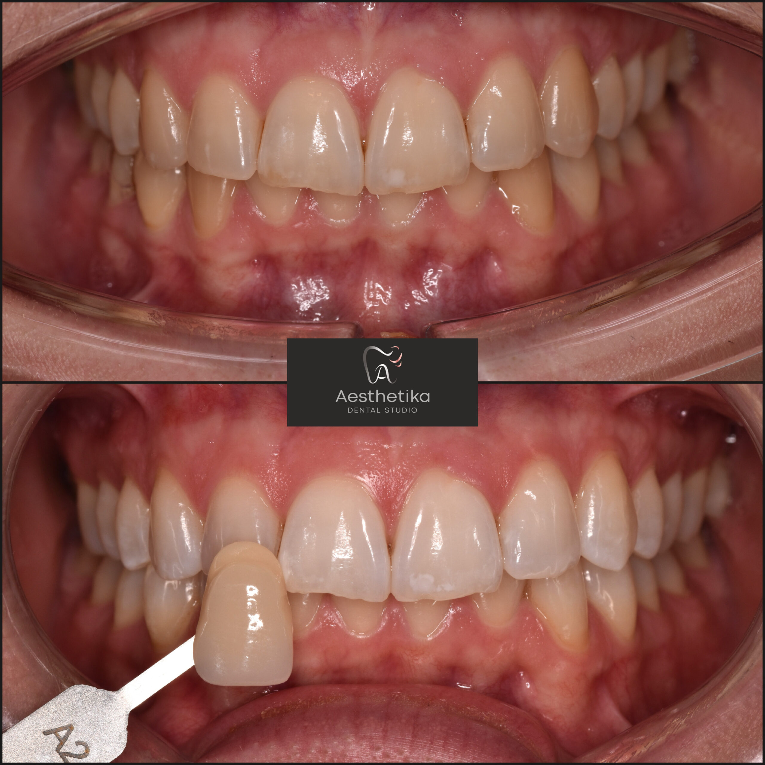 Aesthetika Dental Studio before and after Teeth Whitening