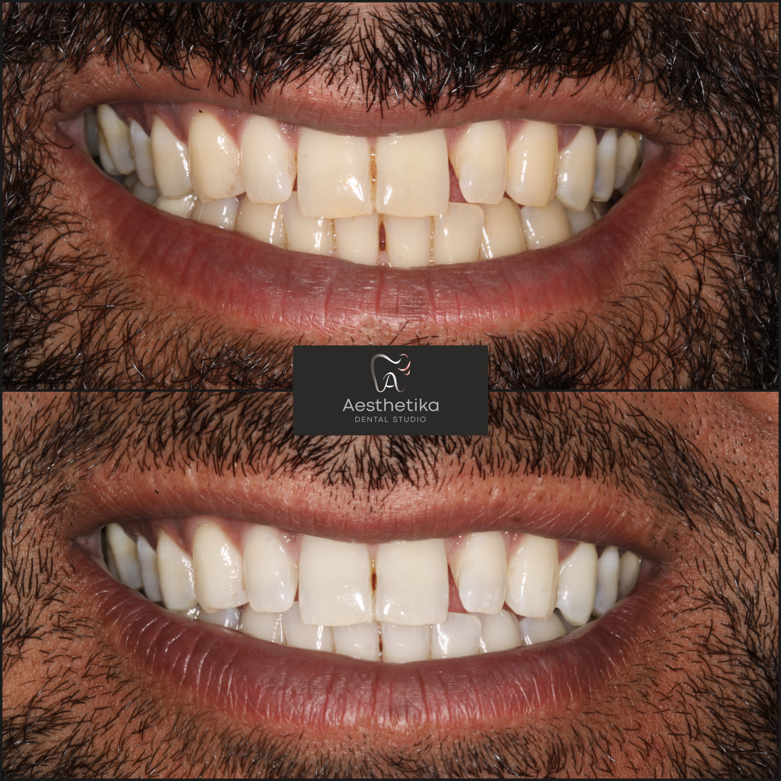 Aesthetika Dental Studio before and after Teeth Whitening