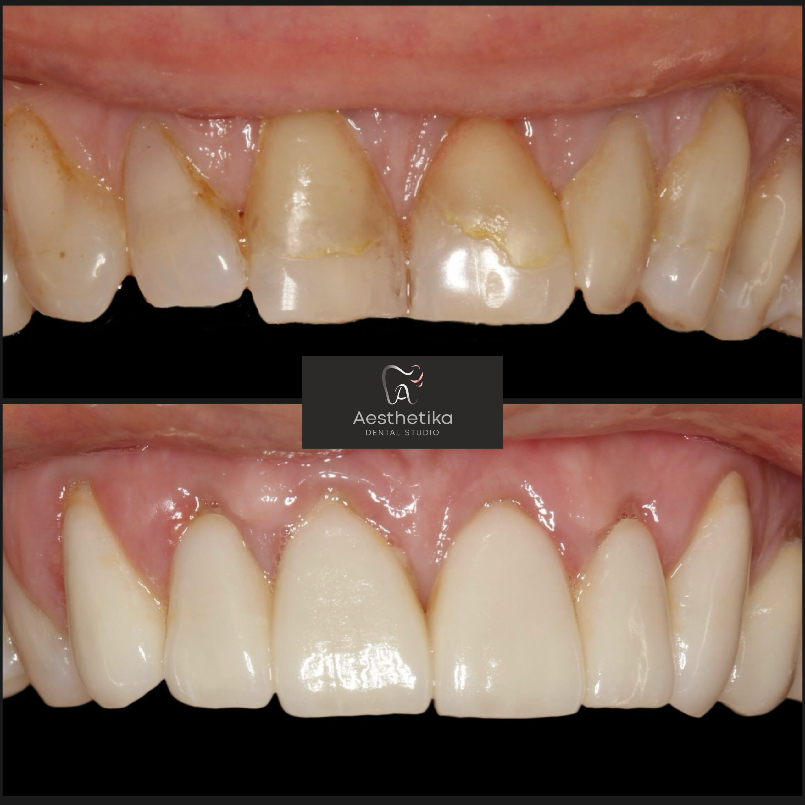 Aesthetika Dental Studio before and after Veneers