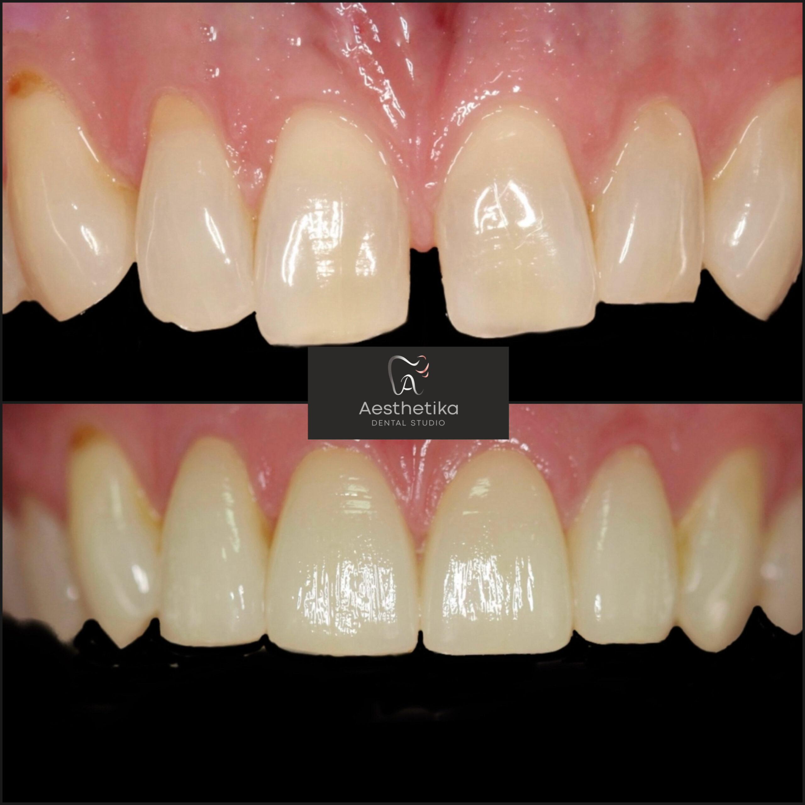 Aesthetika Dental Studio before and after Veneers