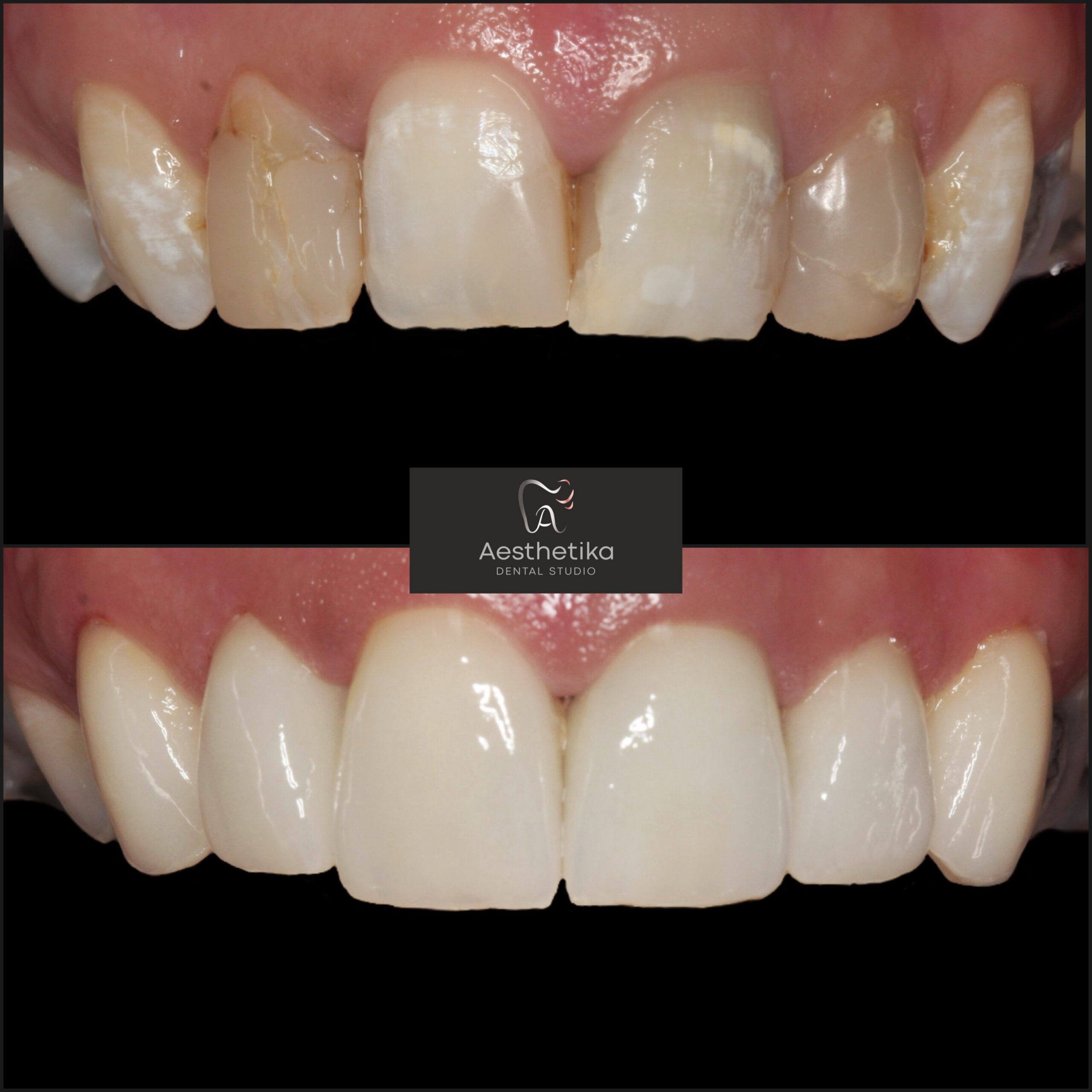 Aesthetika Dental Studio before and after Veneers