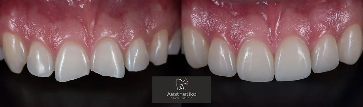 bonding Aesthetika Dental Studio before and after