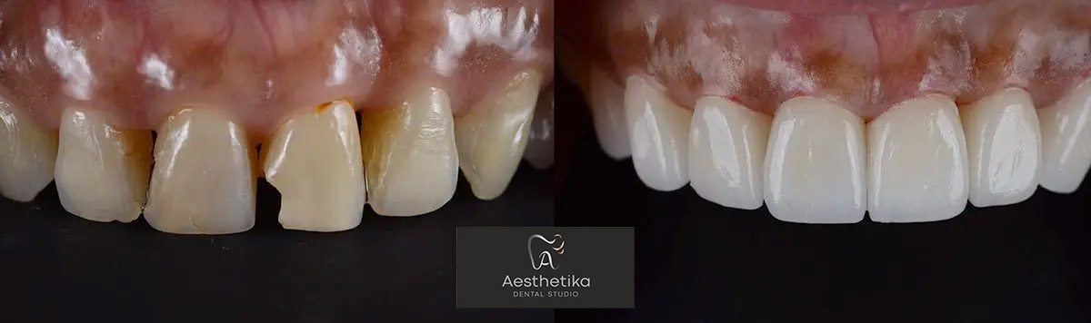 bonding2 Aesthetika Dental Studio before and after